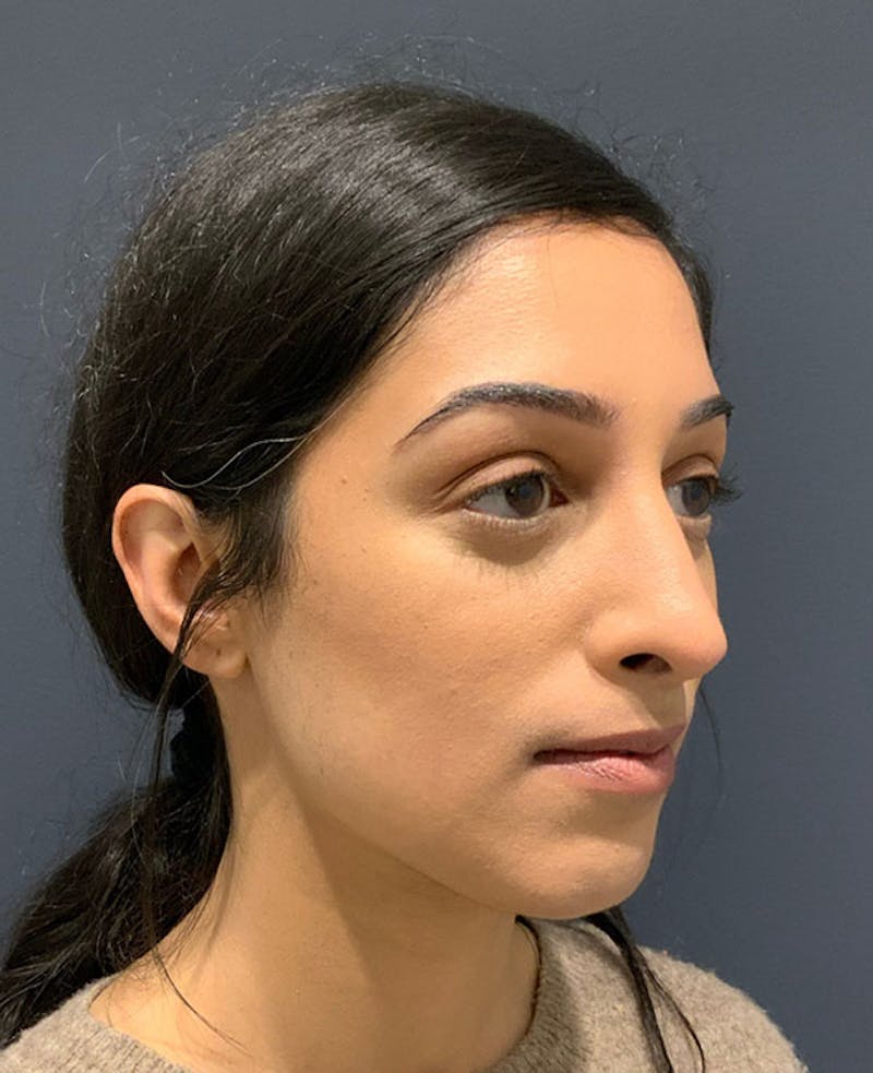 Ultrasonic Rhinoplasty Before & After Gallery - Patient 113010 - Image 6