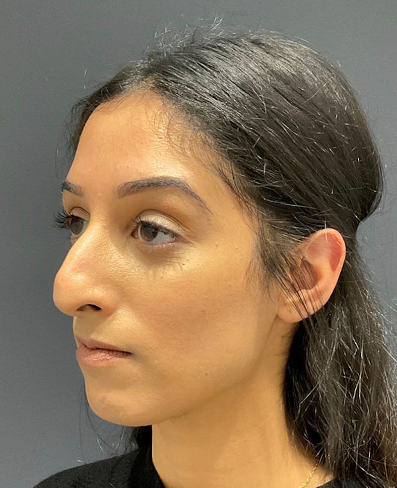 Ultrasonic Rhinoplasty Before & After Gallery - Patient 113010 - Image 7