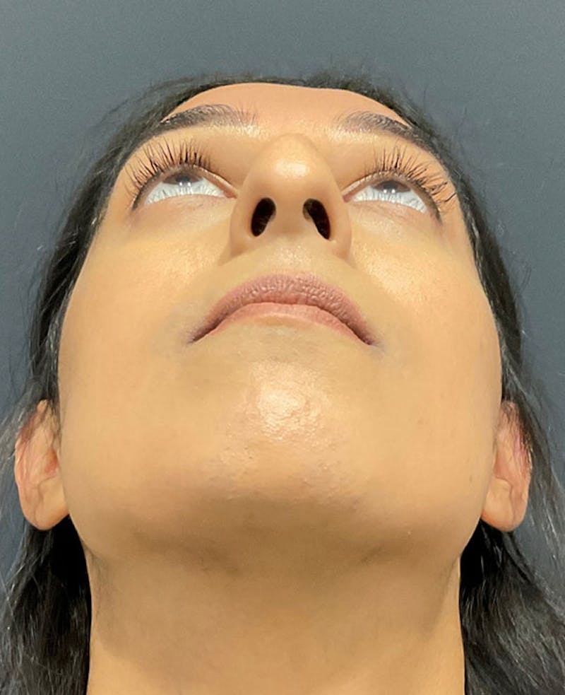 Ultrasonic Rhinoplasty Before & After Gallery - Patient 113010 - Image 9