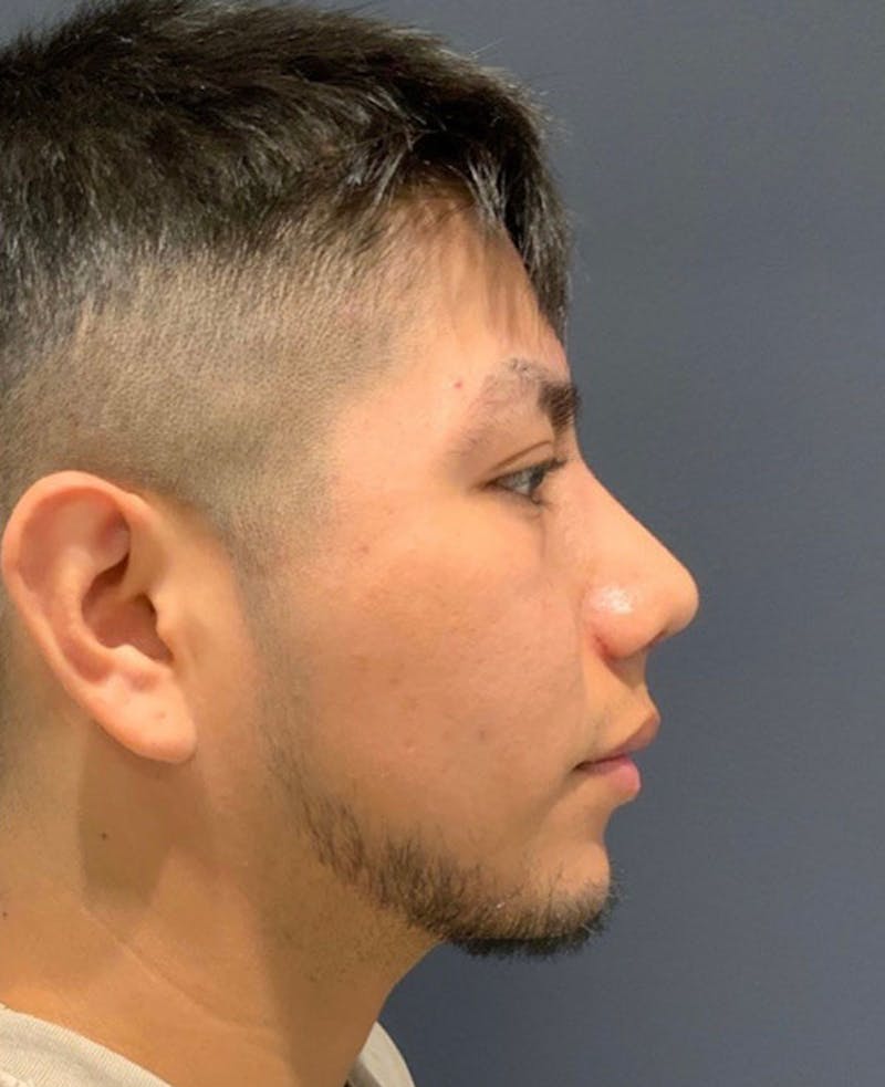 Ultrasonic Rhinoplasty Before & After Gallery - Patient 170375 - Image 2