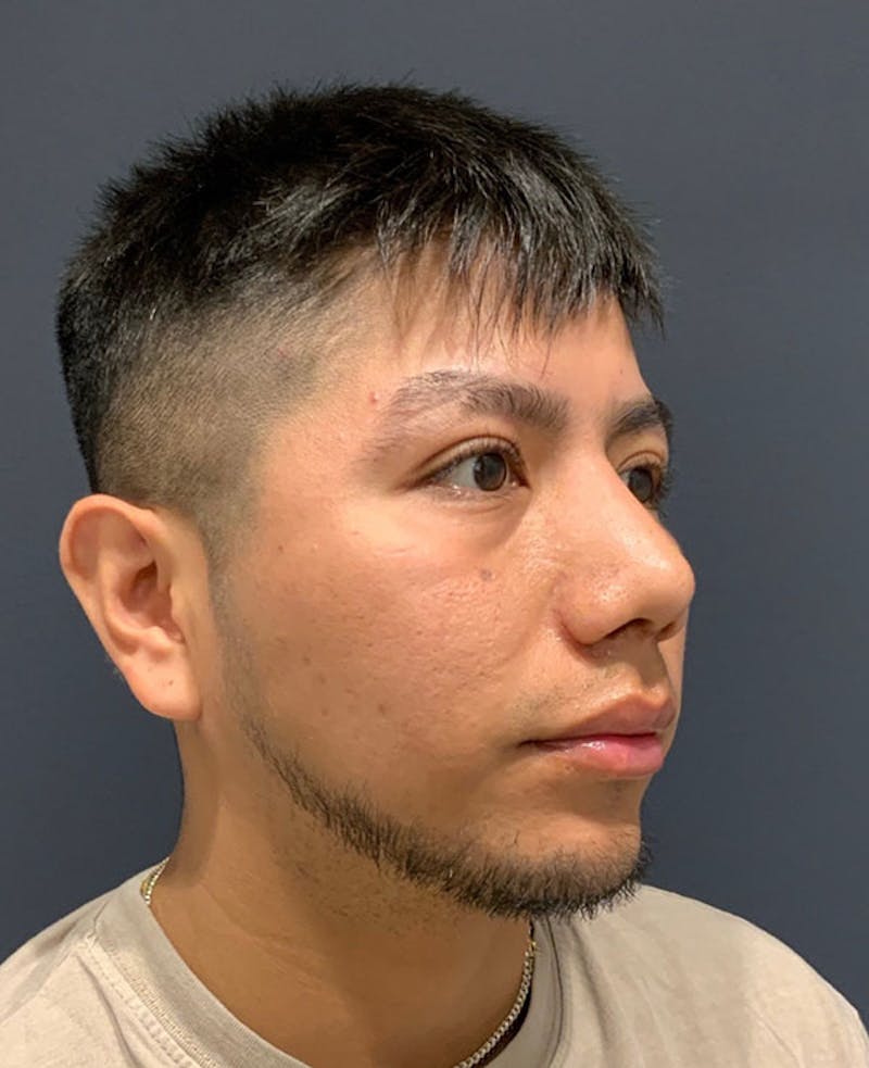 Ultrasonic Rhinoplasty Before & After Gallery - Patient 170375 - Image 6