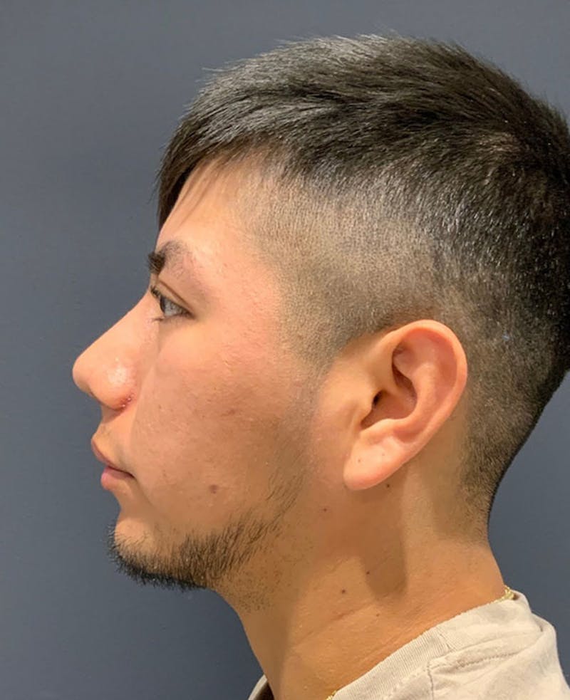 Ultrasonic Rhinoplasty Before & After Gallery - Patient 170375 - Image 10