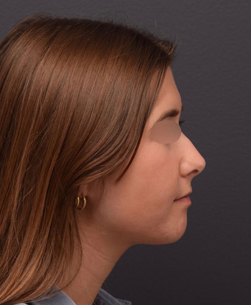 Ultrasonic Rhinoplasty Before & After Gallery - Patient 205811 - Image 1