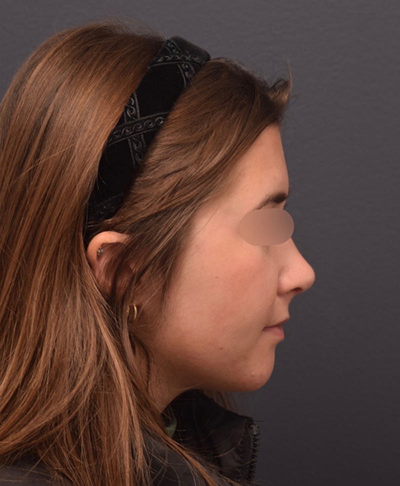 Ultrasonic Rhinoplasty Before & After Gallery - Patient 205811 - Image 2