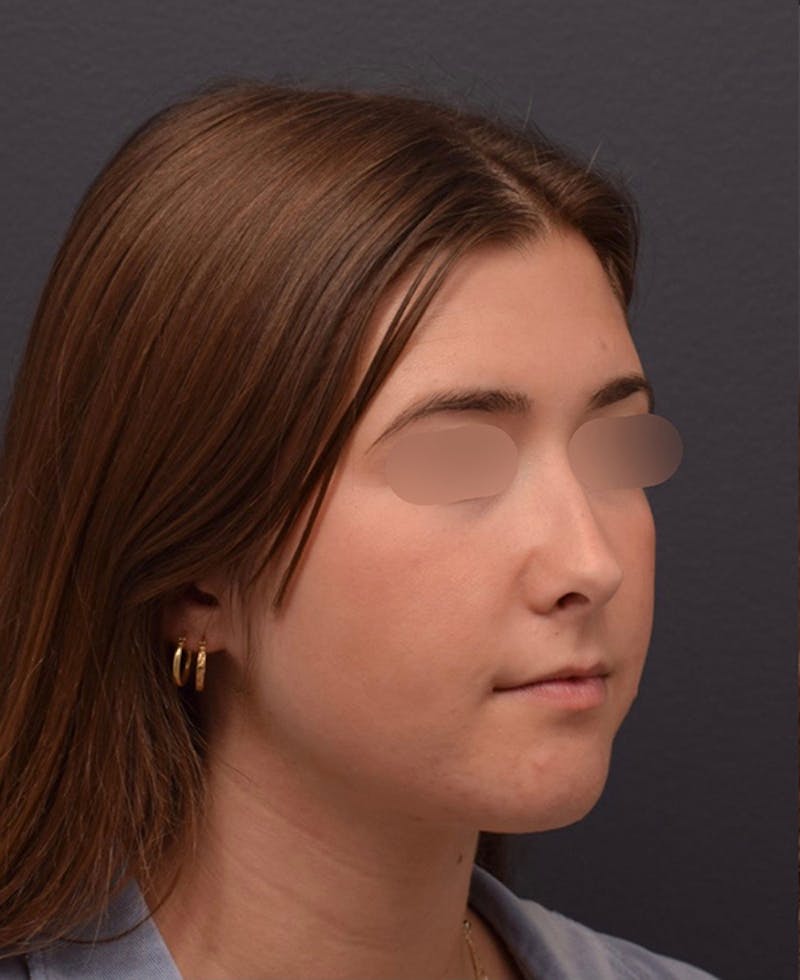 Ultrasonic Rhinoplasty Before & After Gallery - Patient 205811 - Image 5