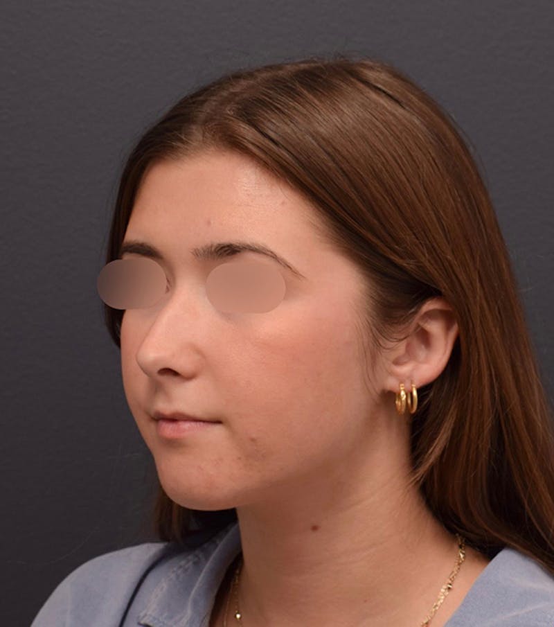Ultrasonic Rhinoplasty Before & After Gallery - Patient 205811 - Image 7