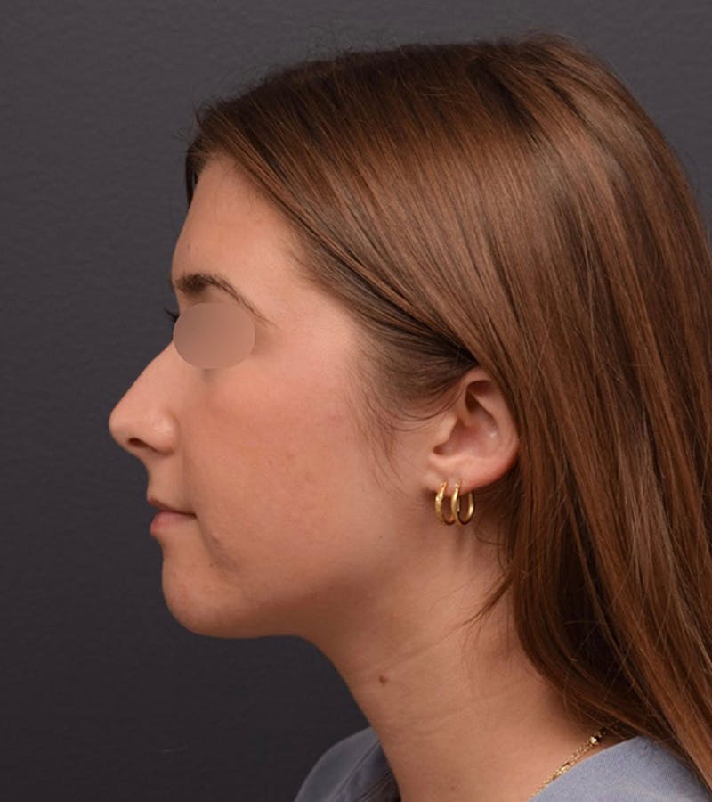 Ultrasonic Rhinoplasty Before & After Gallery - Patient 205811 - Image 9