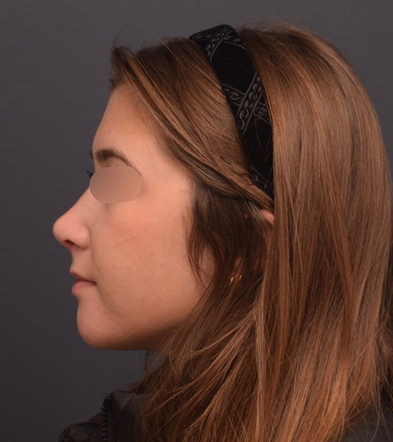 Ultrasonic Rhinoplasty Before & After Gallery - Patient 205811 - Image 10