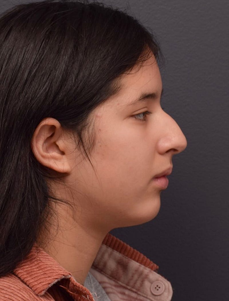 Ultrasonic Rhinoplasty Before & After Gallery - Patient 413700 - Image 1