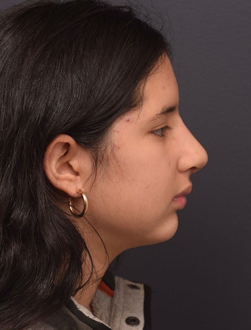 Ultrasonic Rhinoplasty Before & After Gallery - Patient 413700 - Image 2