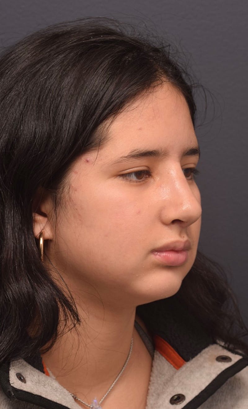 Ultrasonic Rhinoplasty Before & After Gallery - Patient 413700 - Image 6