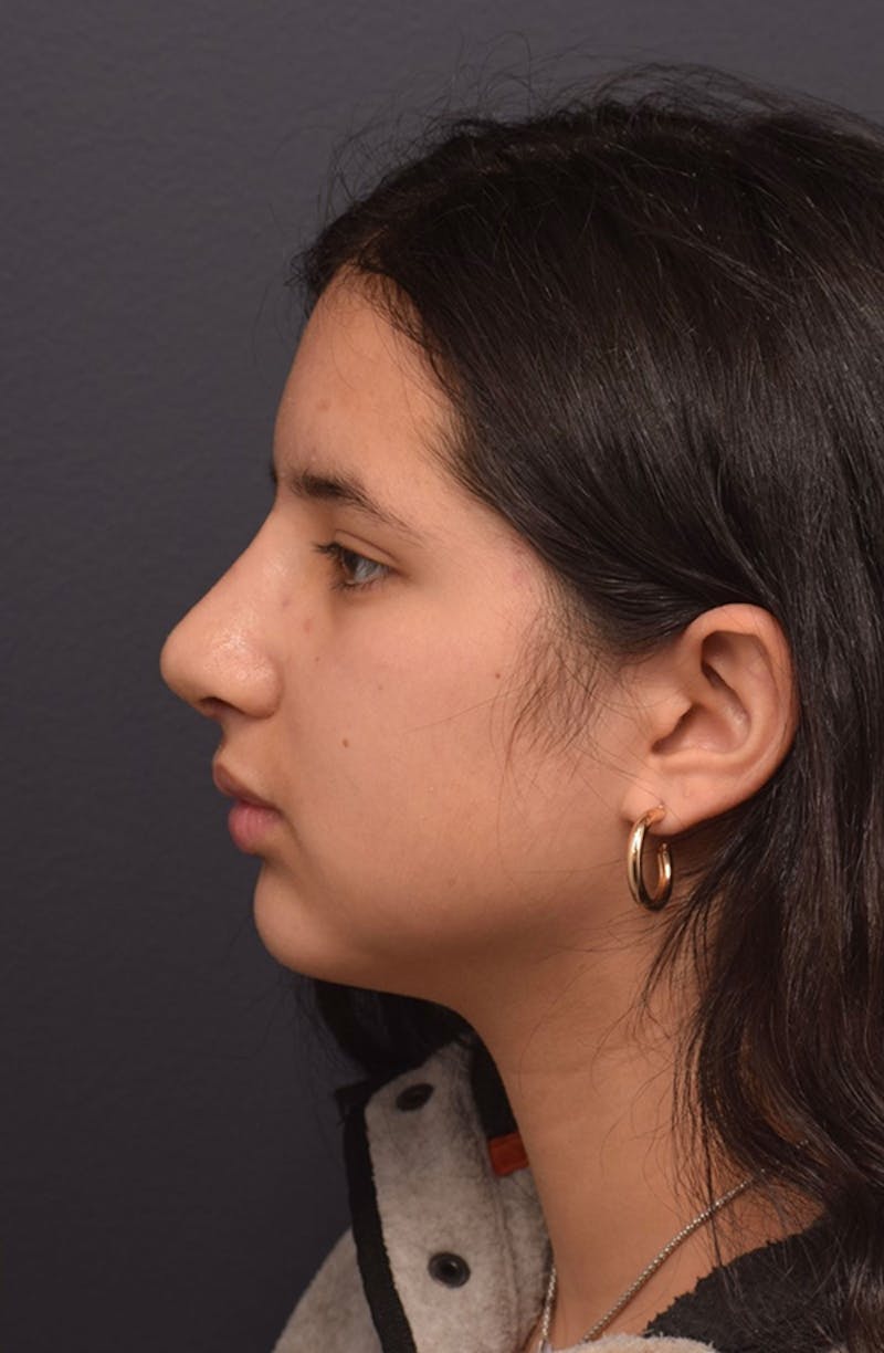 Ultrasonic Rhinoplasty Before & After Gallery - Patient 413700 - Image 10