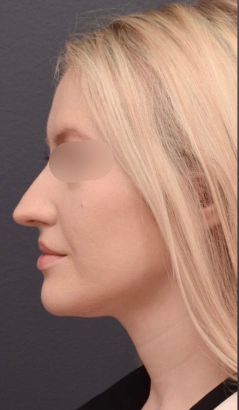 Ultrasonic Rhinoplasty Before & After Gallery - Patient 305559 - Image 1