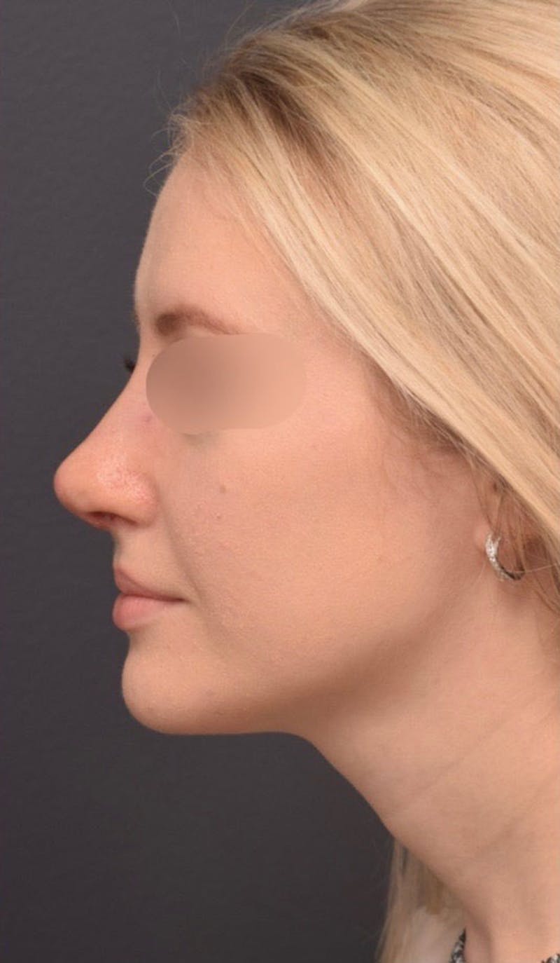 Ultrasonic Rhinoplasty Before & After Gallery - Patient 305559 - Image 2