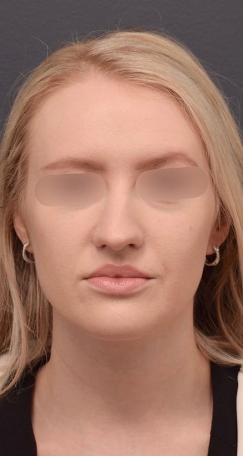 Ultrasonic Rhinoplasty Before & After Gallery - Patient 305559 - Image 3