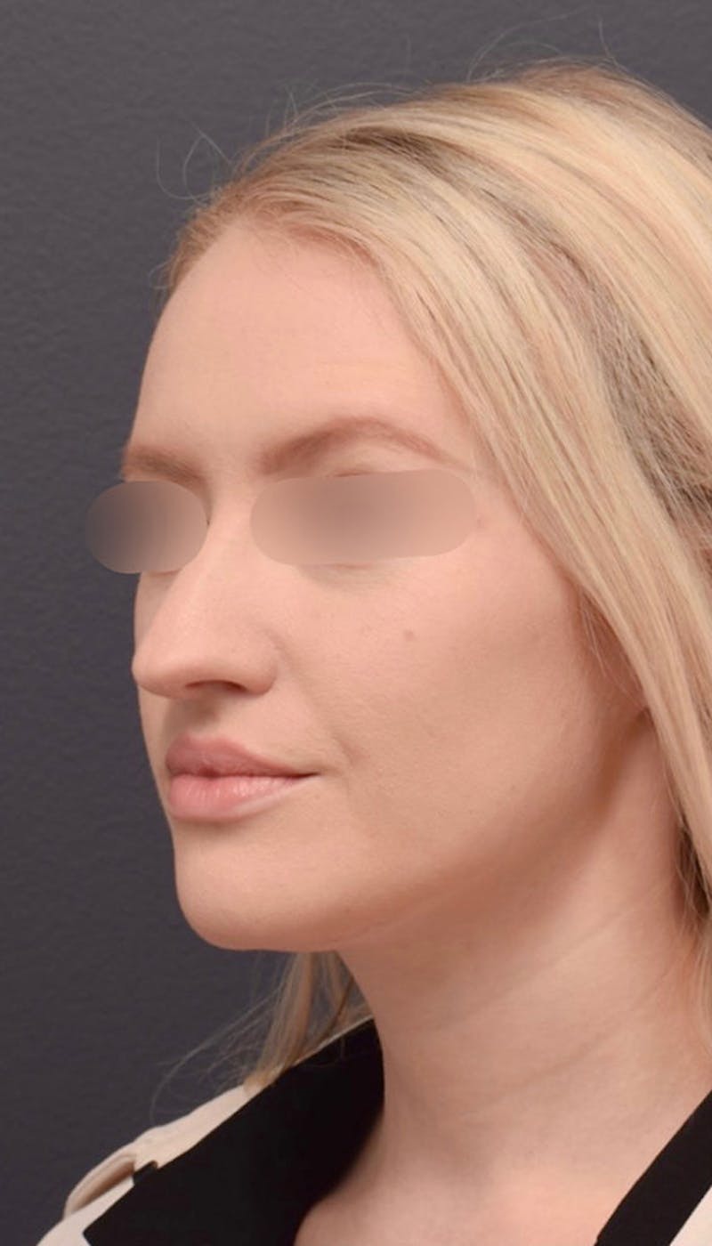 Ultrasonic Rhinoplasty Before & After Gallery - Patient 305559 - Image 5