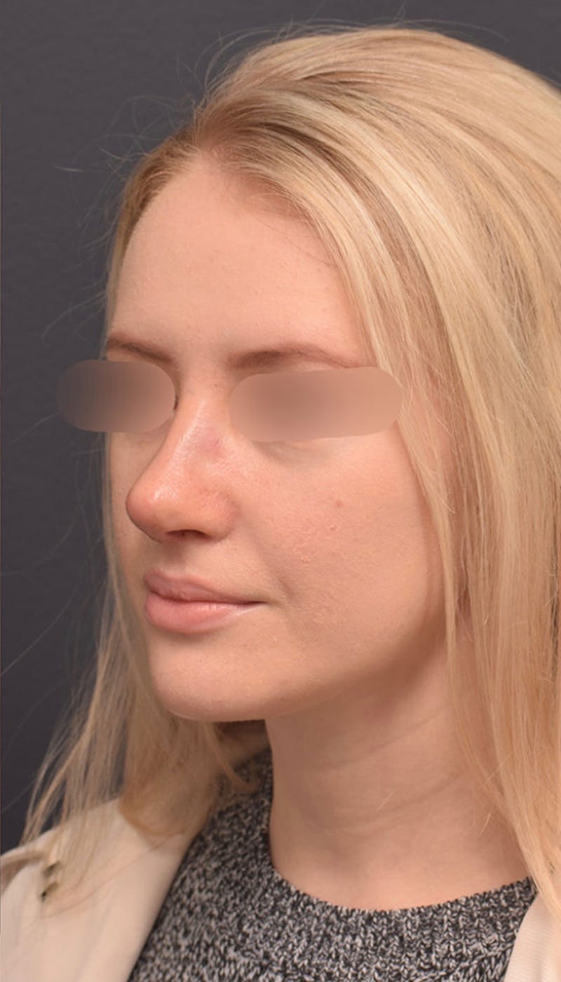 Ultrasonic Rhinoplasty Before & After Gallery - Patient 305559 - Image 6