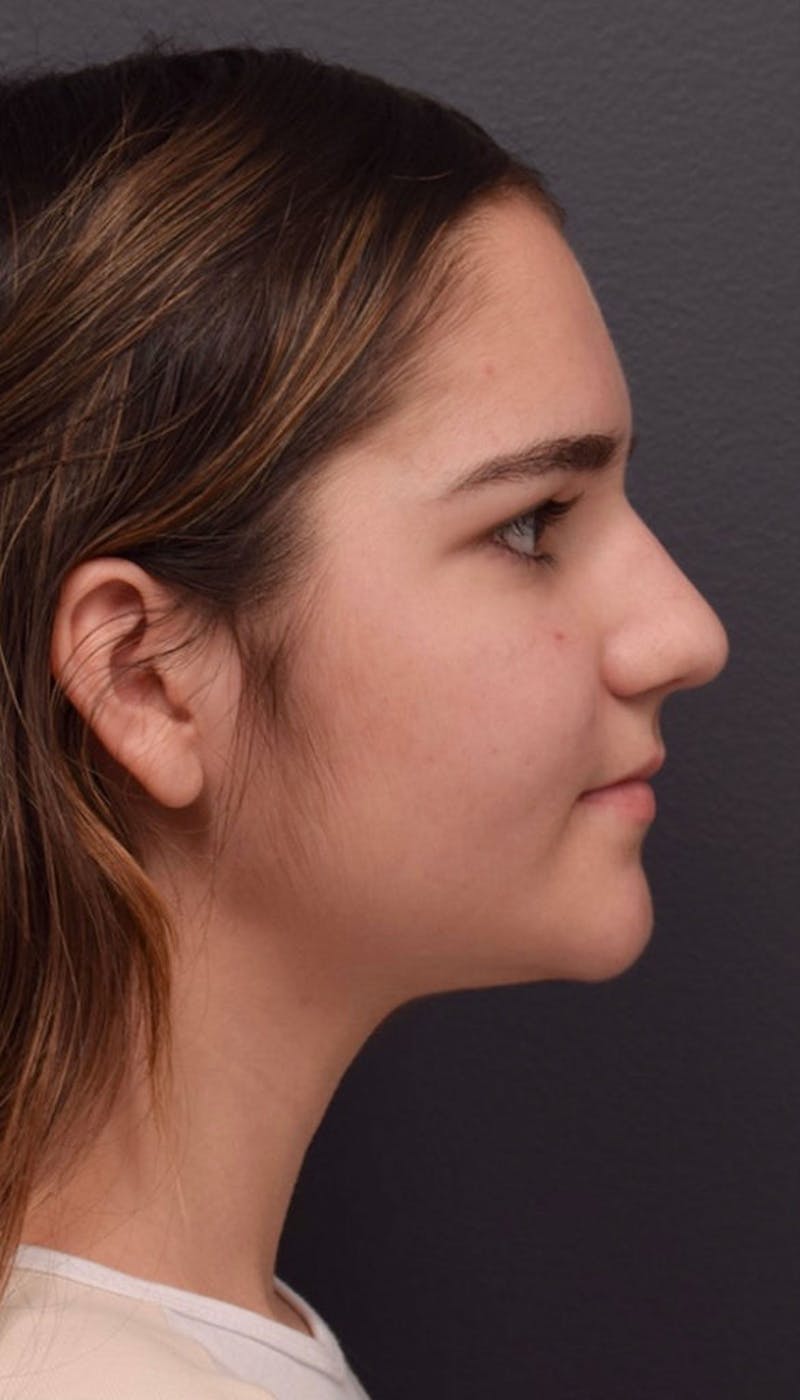 Ultrasonic Rhinoplasty Before & After Gallery - Patient 622380 - Image 1