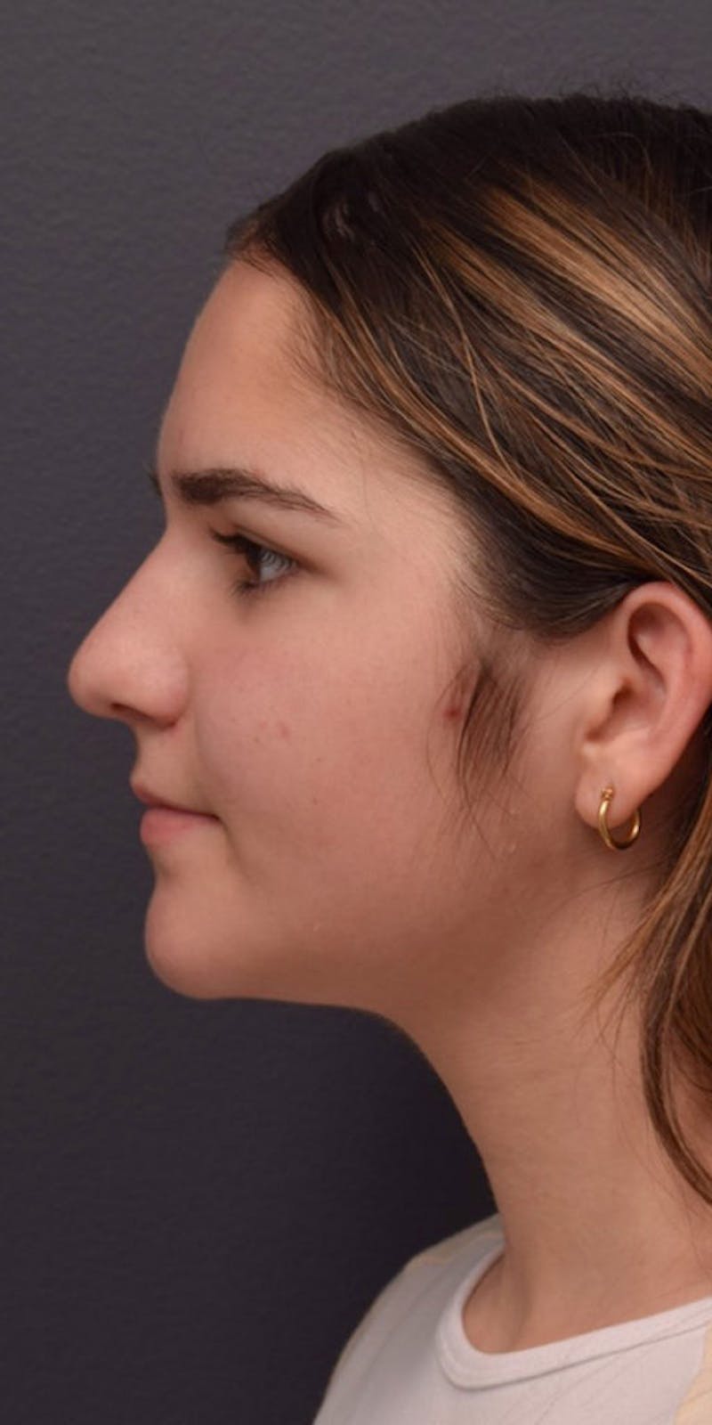 Ultrasonic Rhinoplasty Before & After Gallery - Patient 622380 - Image 9