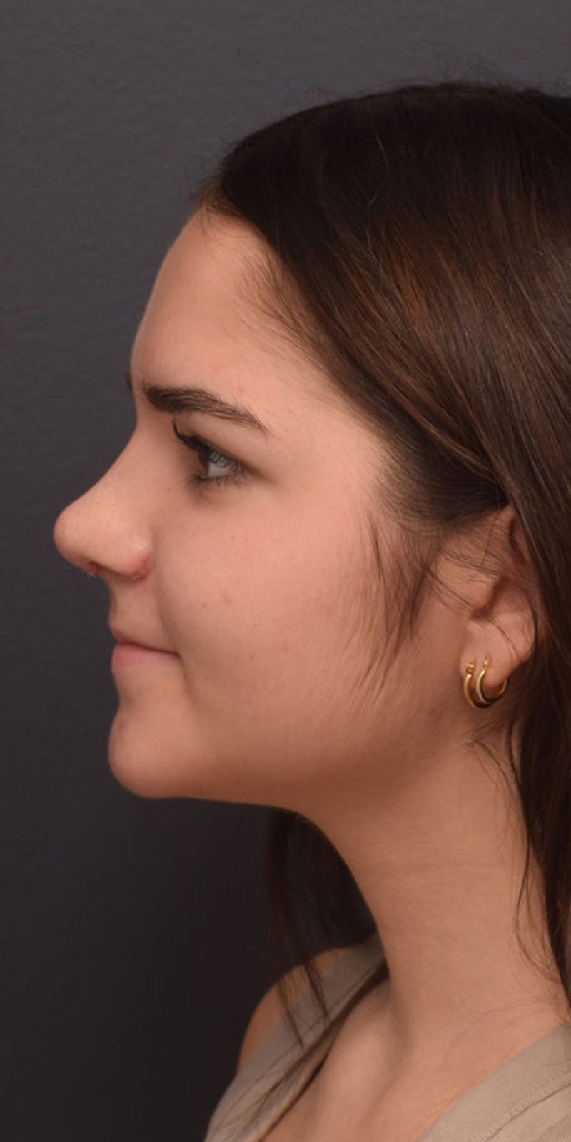 Ultrasonic Rhinoplasty Before & After Gallery - Patient 622380 - Image 10
