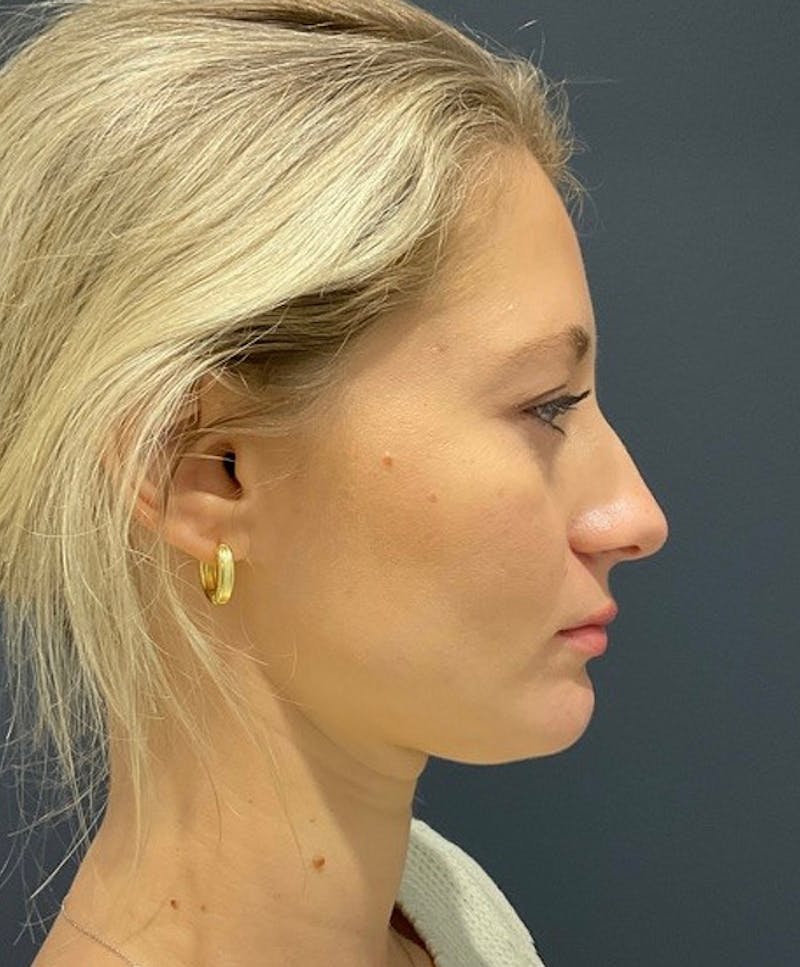 Ultrasonic Rhinoplasty Before & After Gallery - Patient 312509 - Image 1