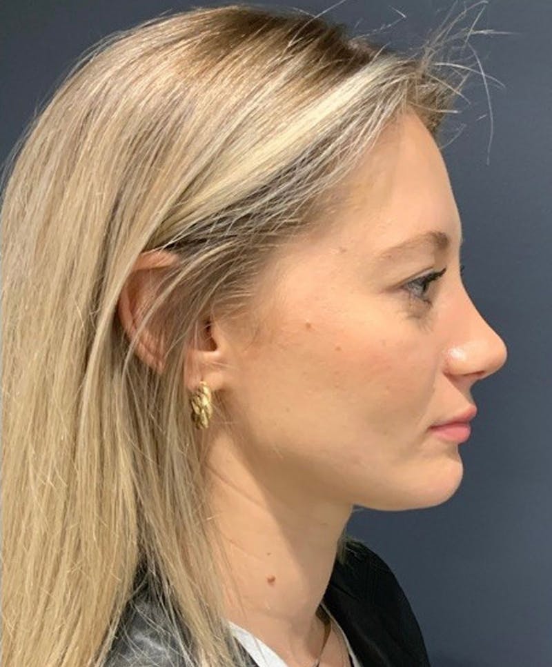 Ultrasonic Rhinoplasty Before & After Gallery - Patient 312509 - Image 2
