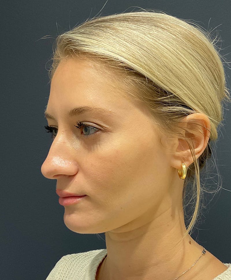 Ultrasonic Rhinoplasty Before & After Gallery - Patient 312509 - Image 3