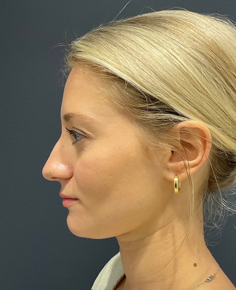 Ultrasonic Rhinoplasty Before & After Gallery - Patient 312509 - Image 5