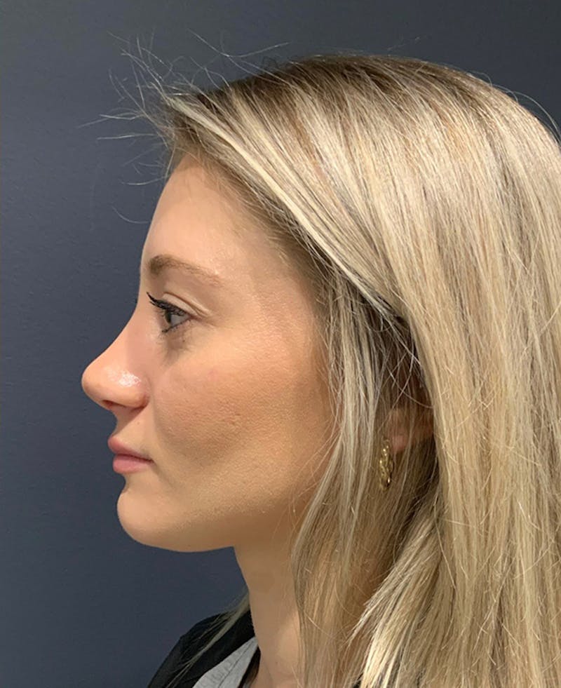 Ultrasonic Rhinoplasty Before & After Gallery - Patient 312509 - Image 6