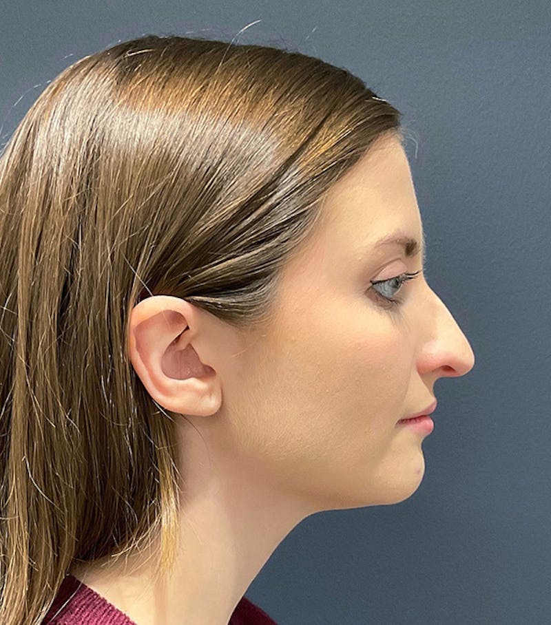 Ultrasonic Rhinoplasty Before & After Gallery - Patient 241968 - Image 1