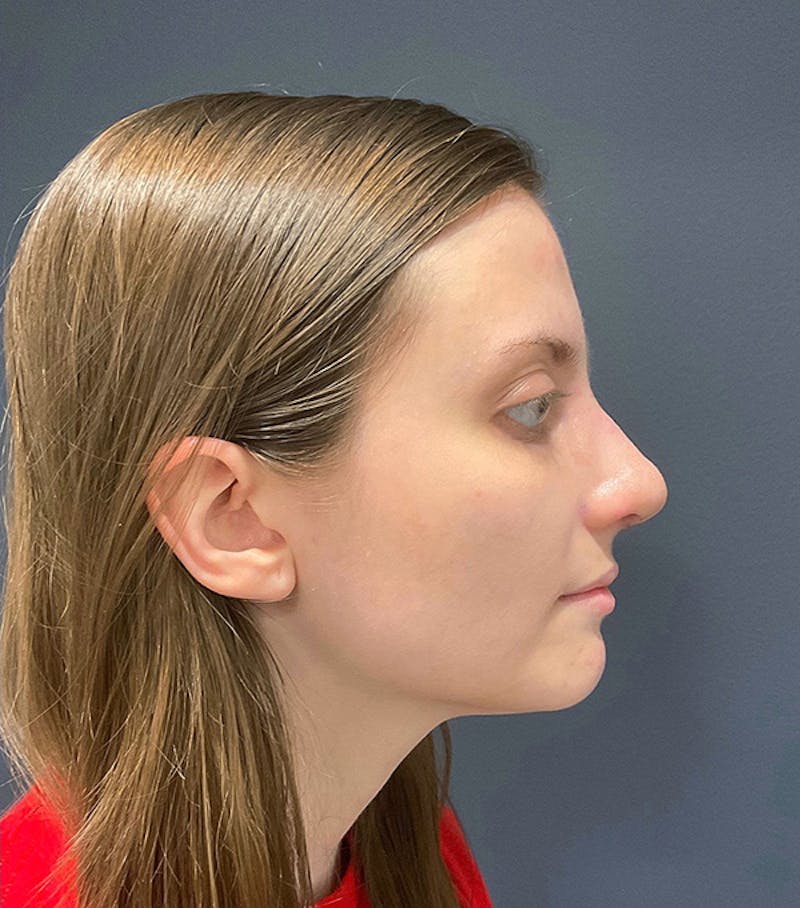 Ultrasonic Rhinoplasty Before & After Gallery - Patient 241968 - Image 2