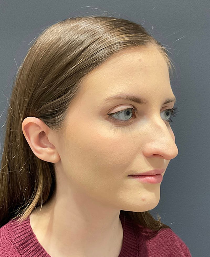 Ultrasonic Rhinoplasty Before & After Gallery - Patient 241968 - Image 3