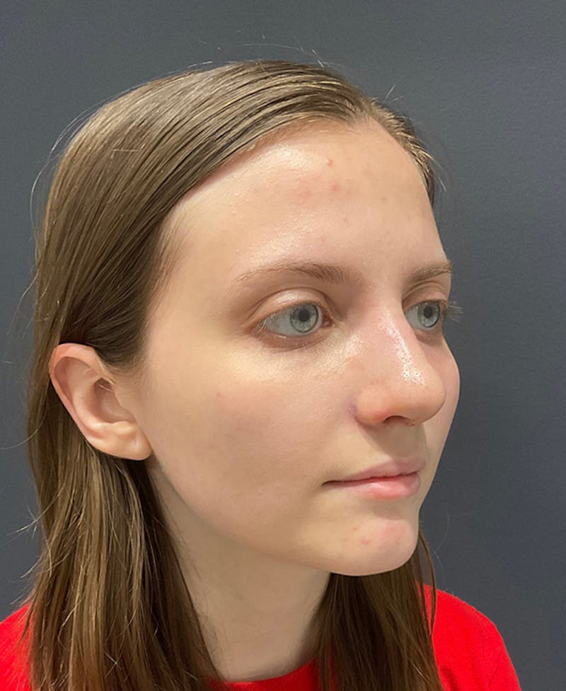 Ultrasonic Rhinoplasty Before & After Gallery - Patient 241968 - Image 4