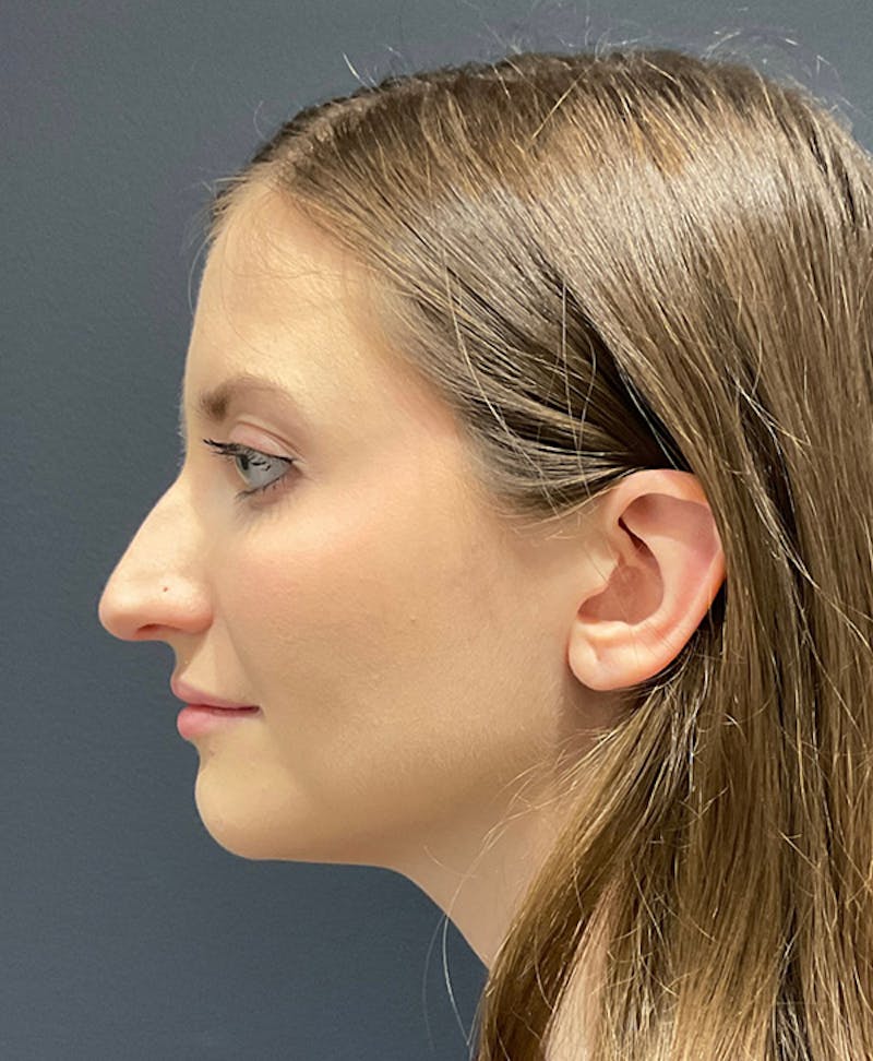 Ultrasonic Rhinoplasty Before & After Gallery - Patient 241968 - Image 5