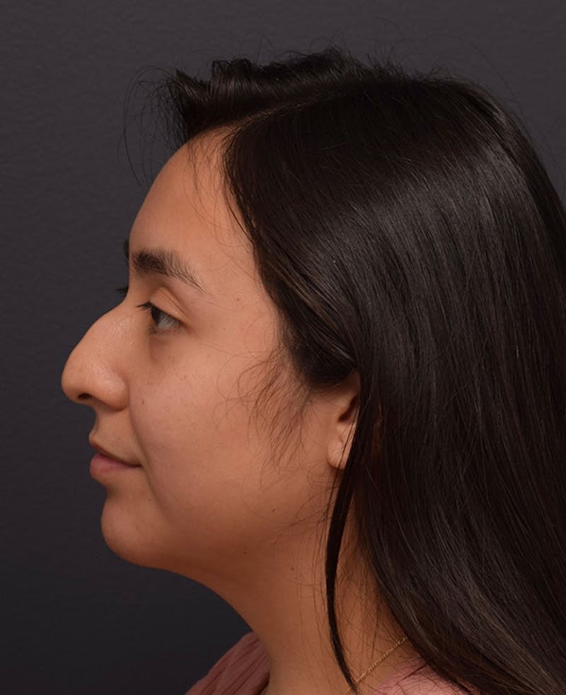 Ultrasonic Rhinoplasty Before & After Gallery - Patient 413077 - Image 1