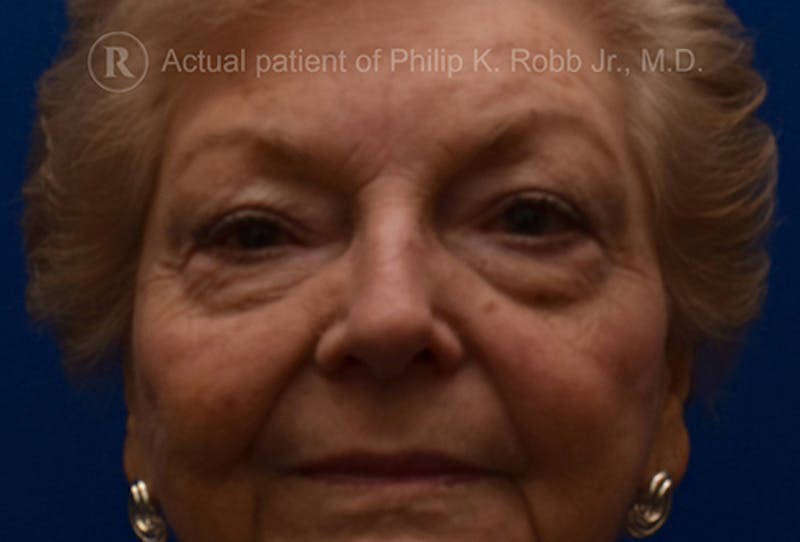 Upper Blepharoplasty Before & After Gallery - Patient 471226 - Image 1