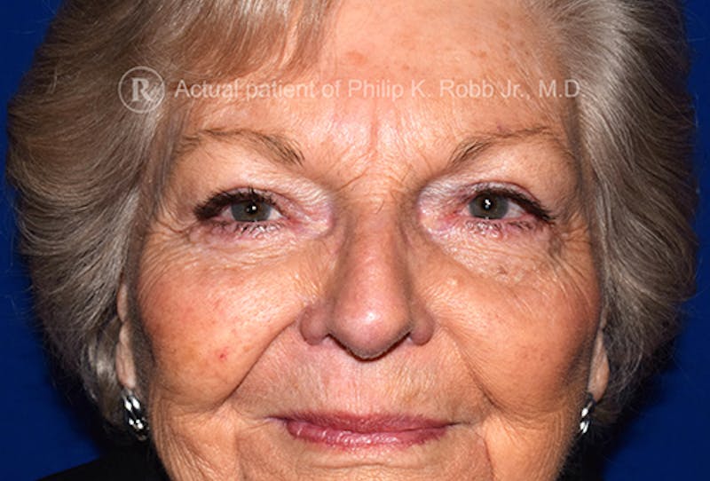 Upper Blepharoplasty Before & After Gallery - Patient 471226 - Image 2
