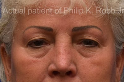 Upper Blepharoplasty Before & After Gallery - Patient 897168 - Image 1