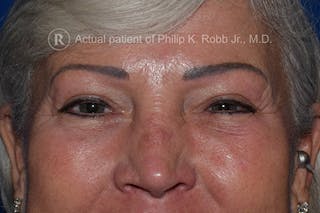 Upper Blepharoplasty Before & After Gallery - Patient 897168 - Image 2