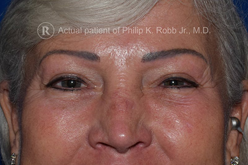 Upper Blepharoplasty Before & After Gallery - Patient 897168 - Image 2