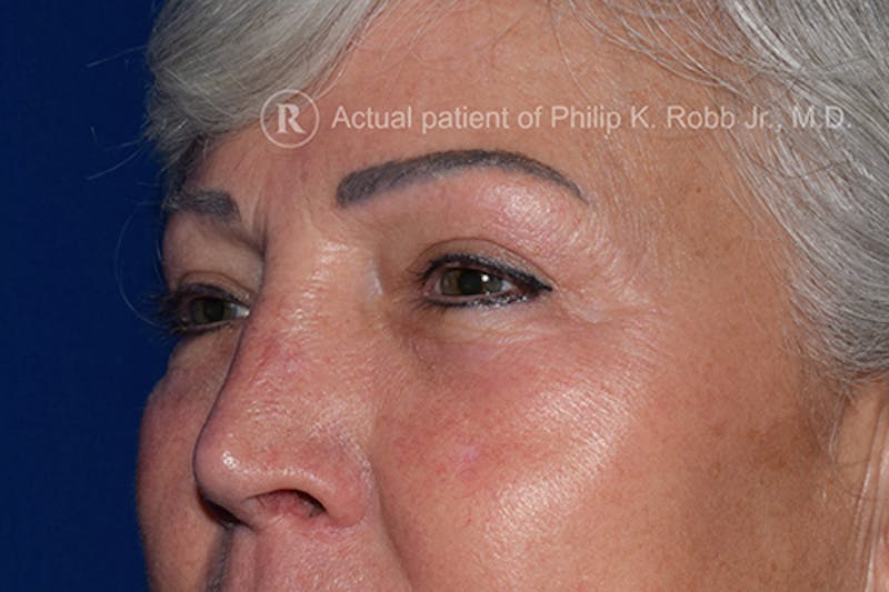 Upper Blepharoplasty Before & After Gallery - Patient 897168 - Image 4