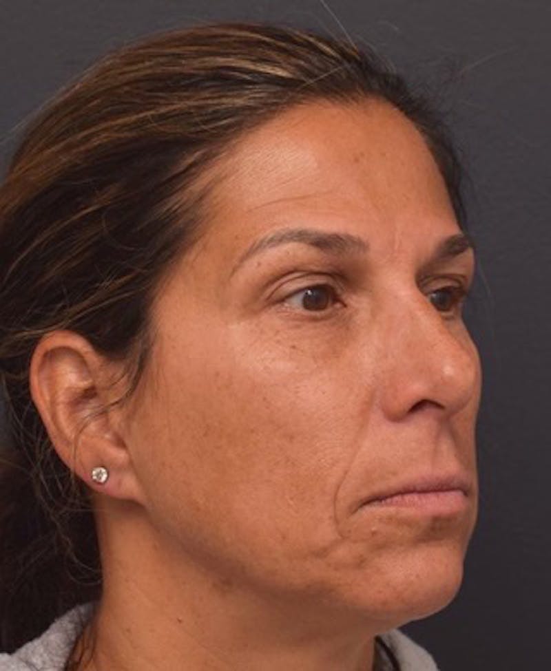 Upper Blepharoplasty Before & After Gallery - Patient 398229 - Image 3