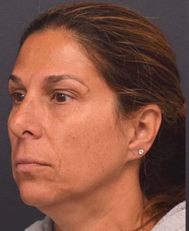 Upper Blepharoplasty Before & After Gallery - Patient 398229 - Image 5