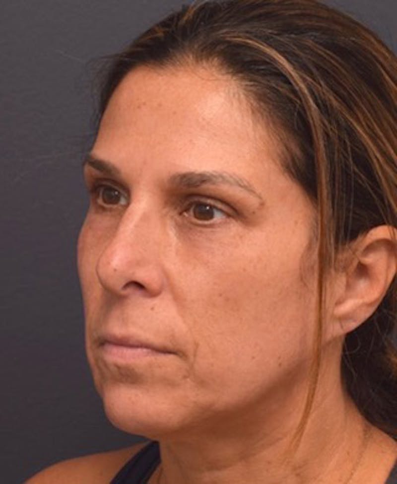 Upper Blepharoplasty Before & After Gallery - Patient 398229 - Image 6