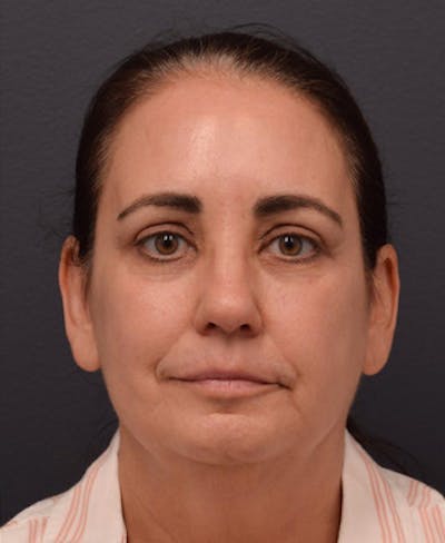 Upper Blepharoplasty Before & After Gallery - Patient 340826 - Image 2