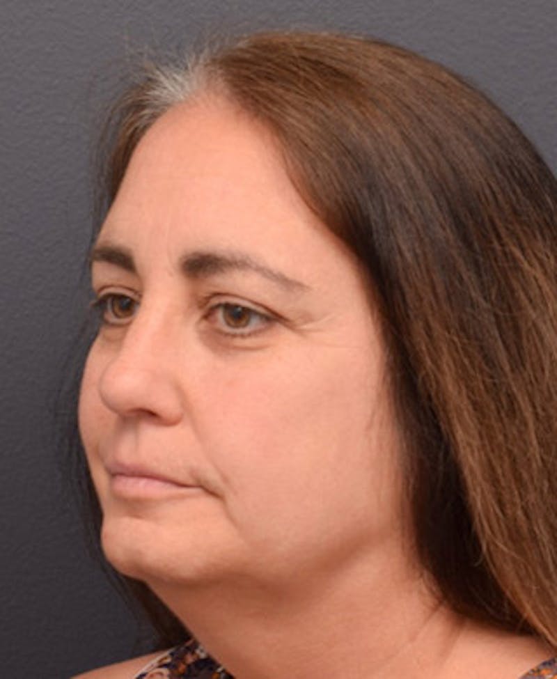 Upper Blepharoplasty Before & After Gallery - Patient 340826 - Image 3