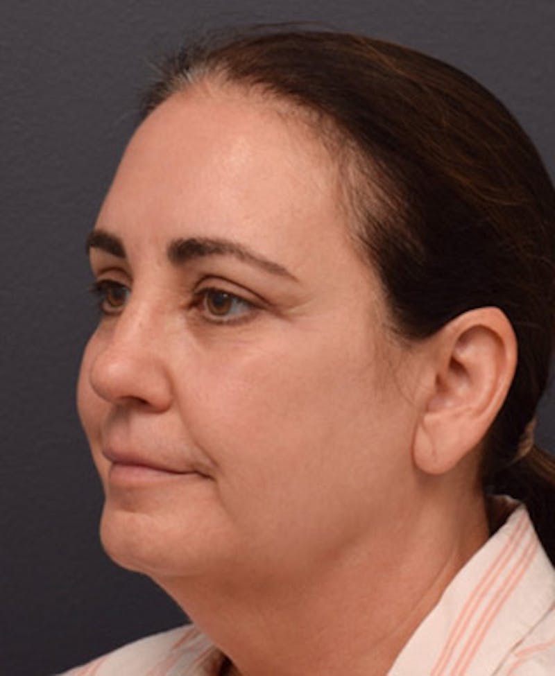 Upper Blepharoplasty Before & After Gallery - Patient 340826 - Image 4