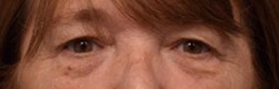 Upper Blepharoplasty Before & After Gallery - Patient 125735 - Image 1