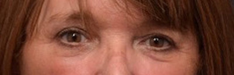 Upper Blepharoplasty Before & After Gallery - Patient 125735 - Image 2