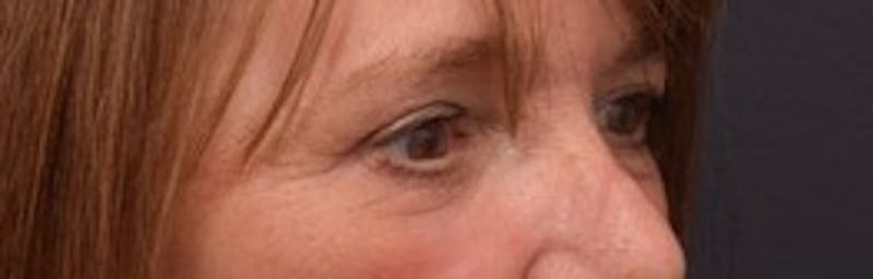 Upper Blepharoplasty Before & After Gallery - Patient 125735 - Image 4